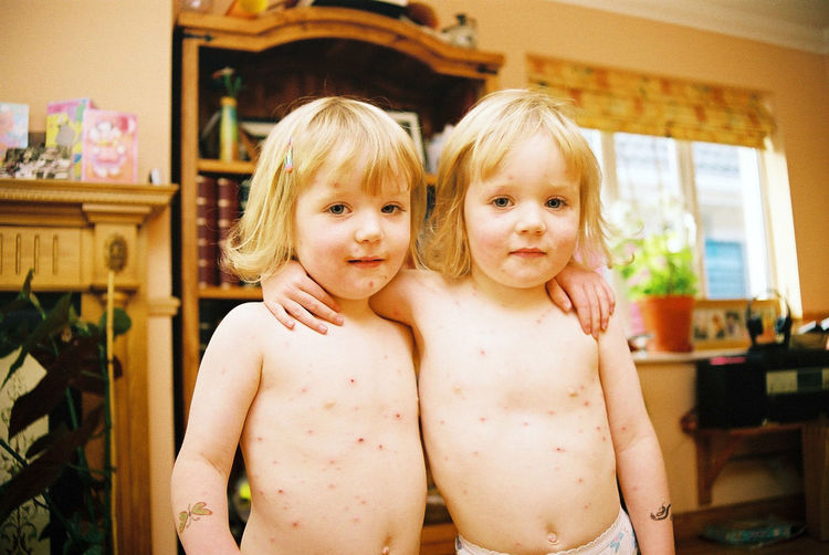 Portrait of siblings suffering from chickenpox standing with arms around at home
