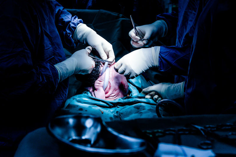 Doctors cutting umbilical cord of newborn baby during operation