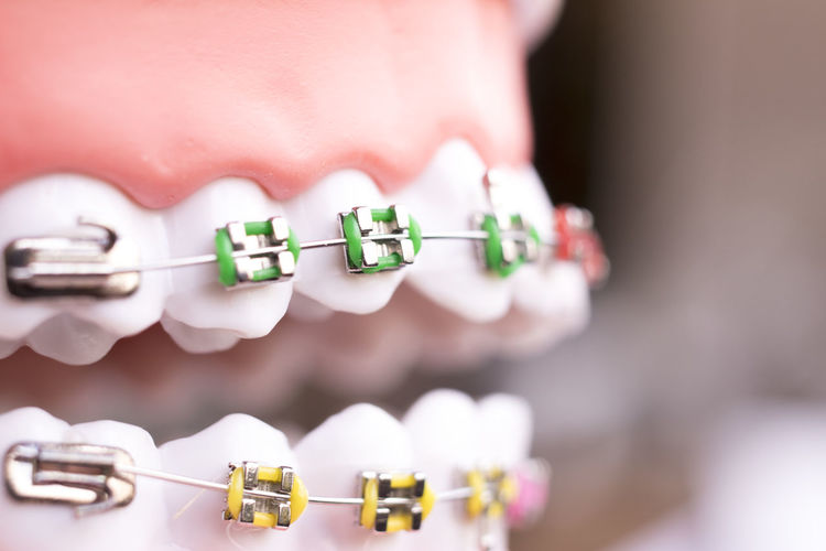 Close-up of braces dentures