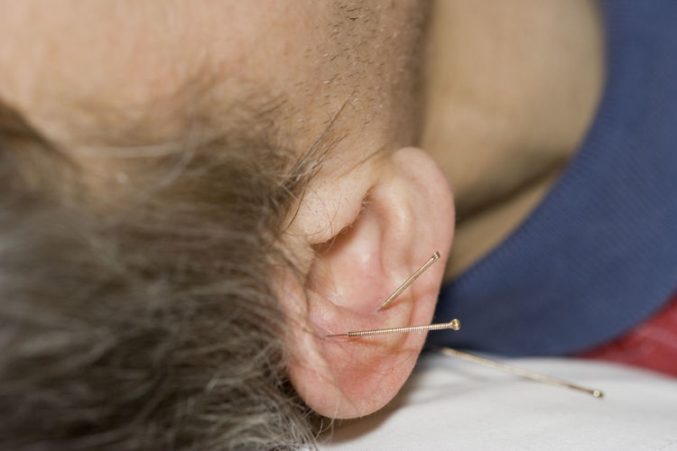Close-up of man with acupuncture needles on ear