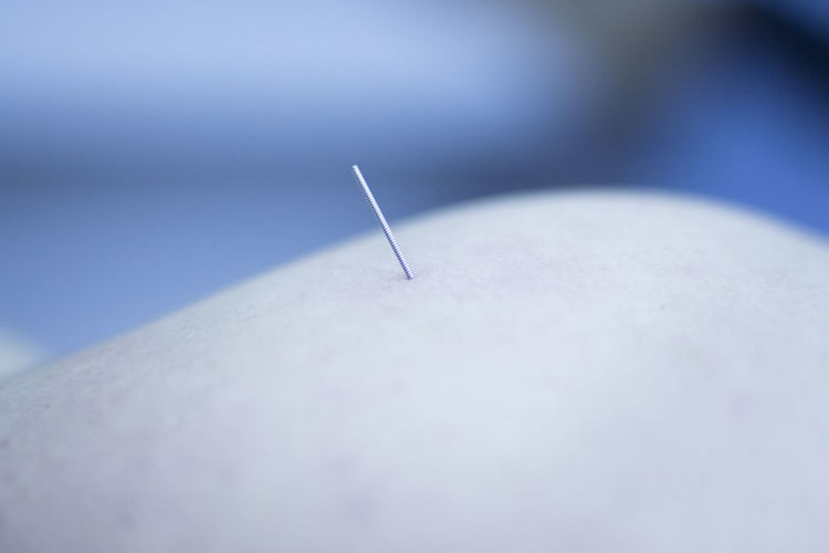 Close-up of acupuncture needle in skin