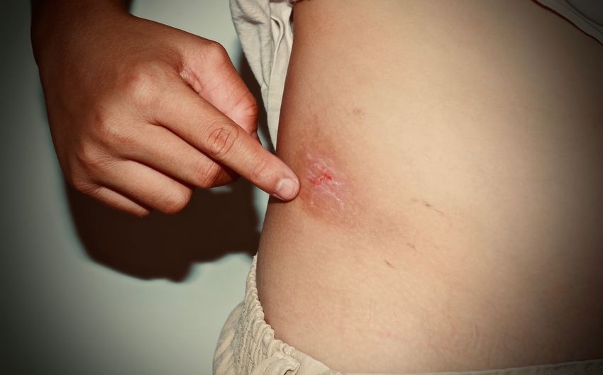 Midsection of woman showing wounded belly