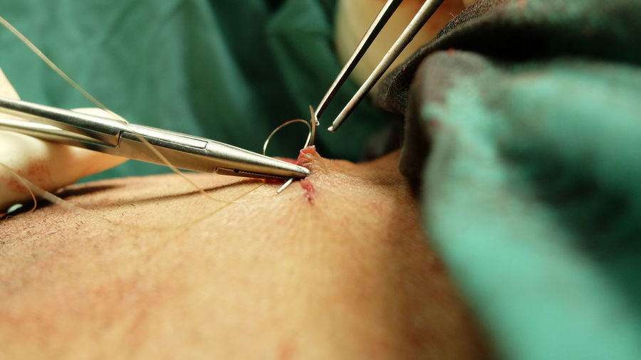 Cropped image of surgeon stitching patient skin