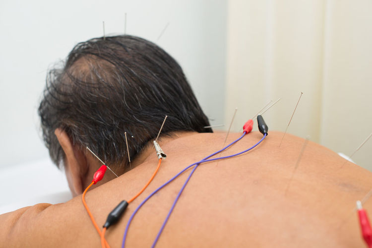 Shirtless man receiving acupuncture treatment