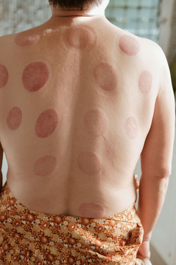 Midsection of shirtless woman with vacuum cupping bruises in clinic
