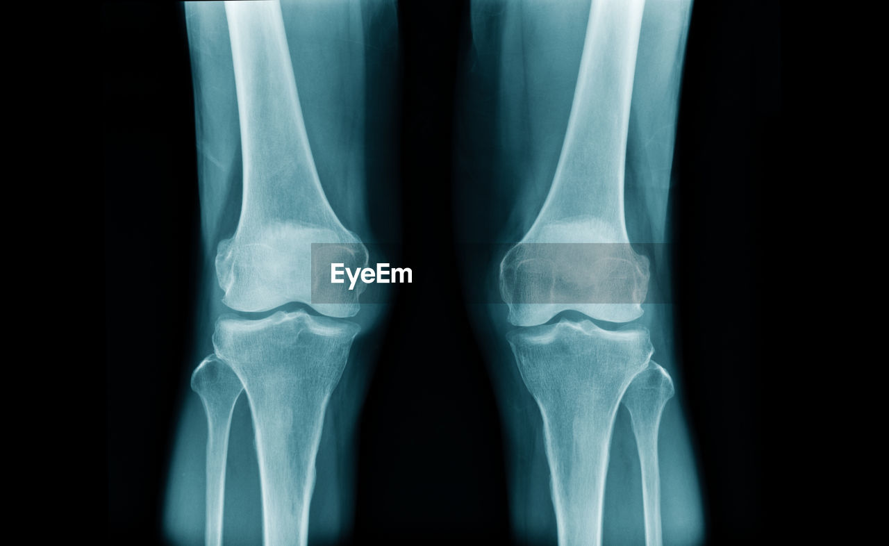 Medical x-ray image of knees and legs