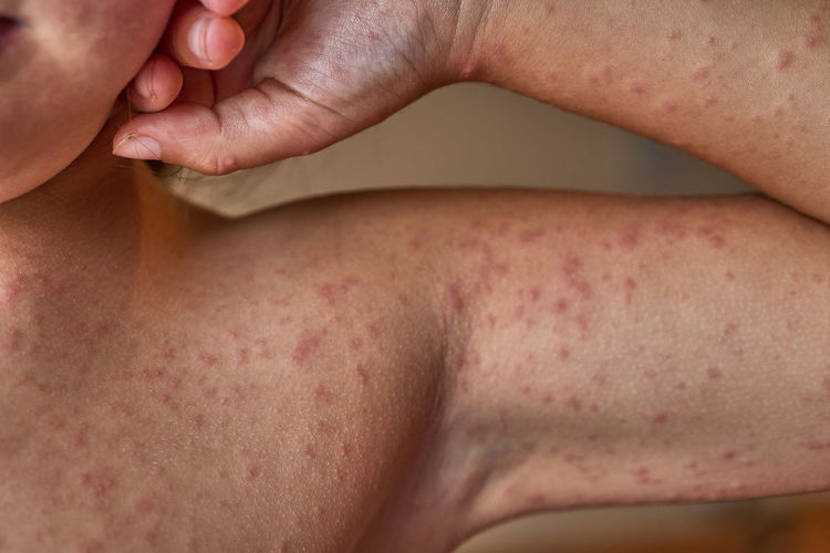 Allergic reaction due to antibiotics, in human skin of a 5-year-old child