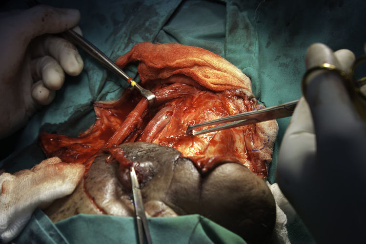 High angle view of doctor performing surgery on patient in hospital